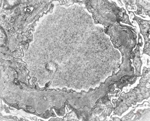 F,49y. | membranous glomerulopathy